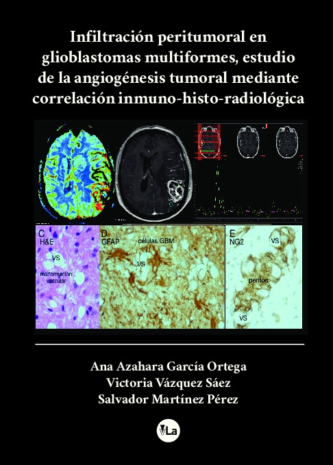 Infiltracion peritumoral en glioblastomas multiformes, estudio de la angiogénesis tumoral mediante correlación inmuno-histo-radiologica