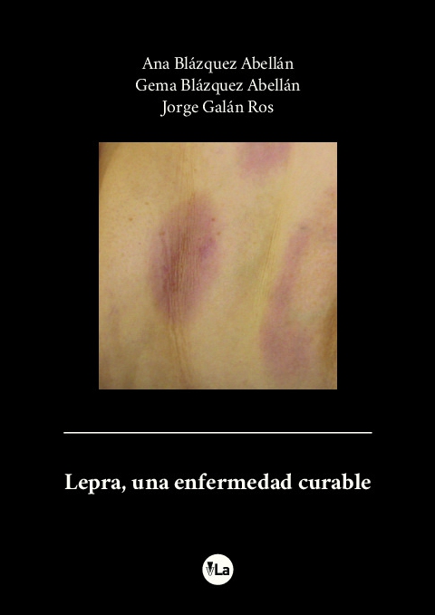 Lepra, una enfermedad curable